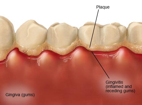 gingivitis information