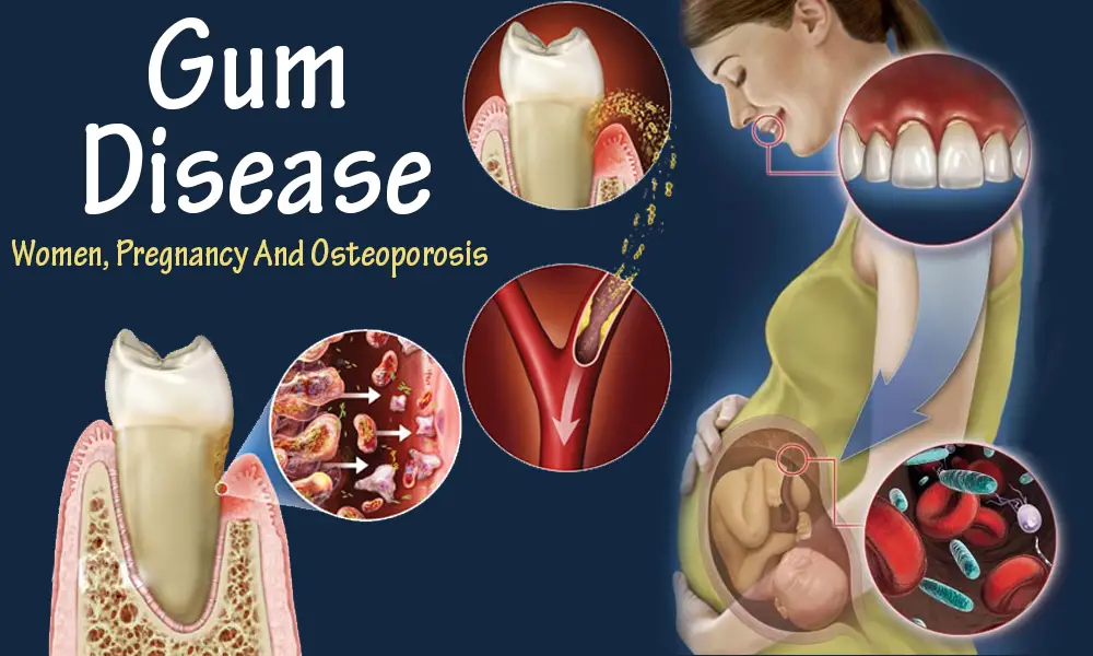 gum disease during pregnancy