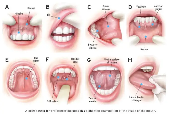 Signs and symptoms Oral Cancer