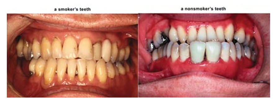 Yellow teeth – smokers vs. nonsmokers
