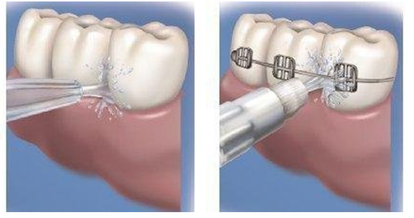 Designed for both normal plaque removal and hoop tooth