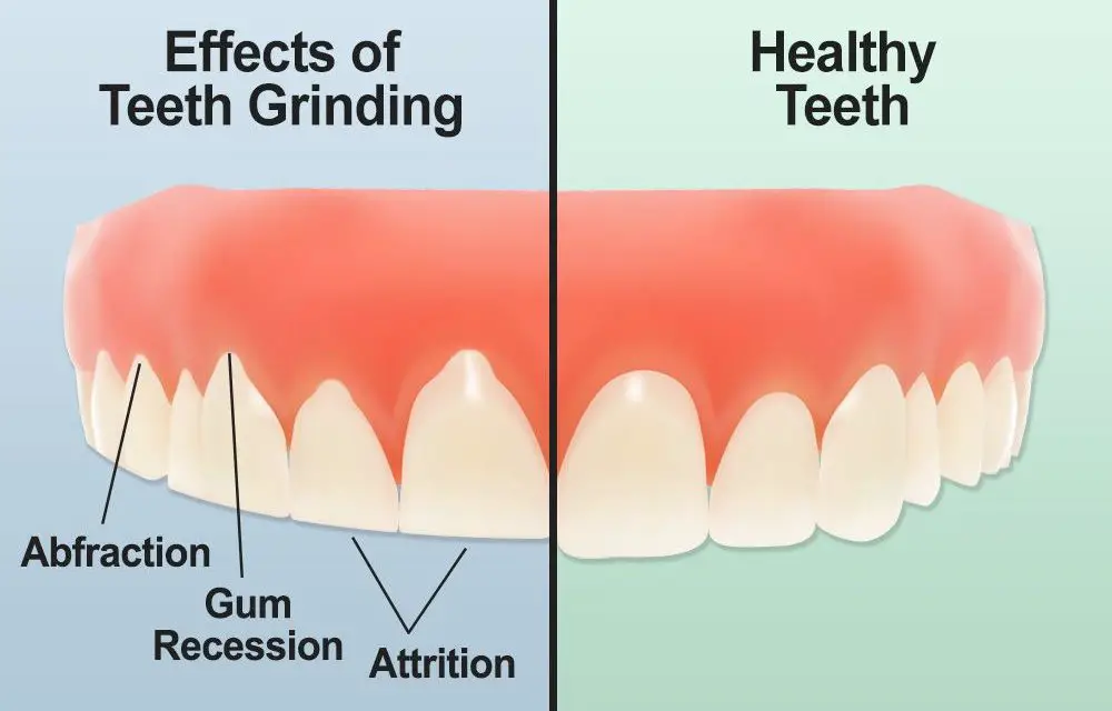 effects of teeth grinding and healthy teeth