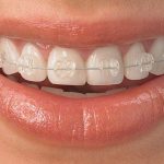 Orthodontic correction