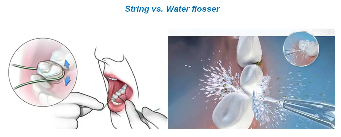 String vs. Water flosser